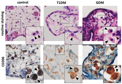 The interplay of inflammation and placenta in maternal diabetes: insights into Hofbauer cell expression patterns